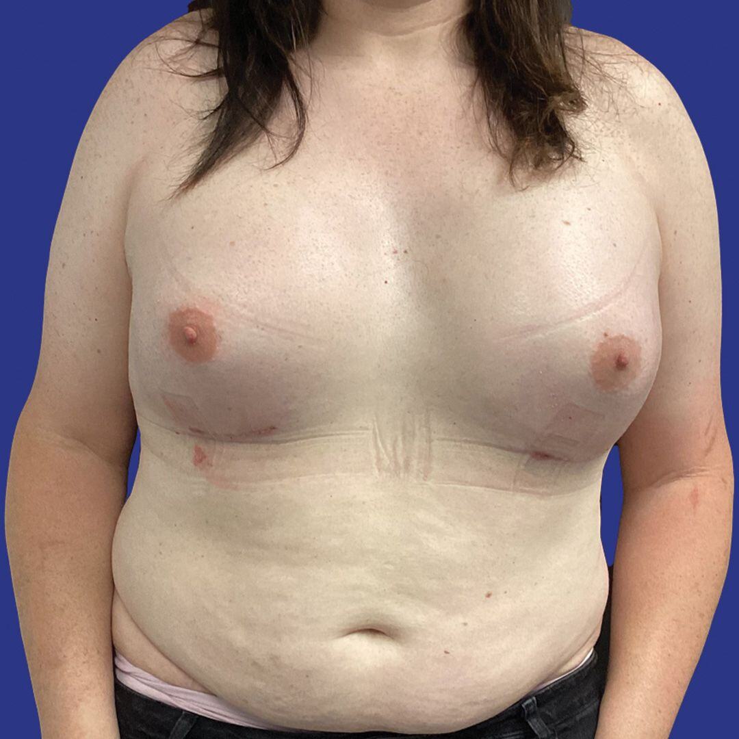 Procedure before and after - after
