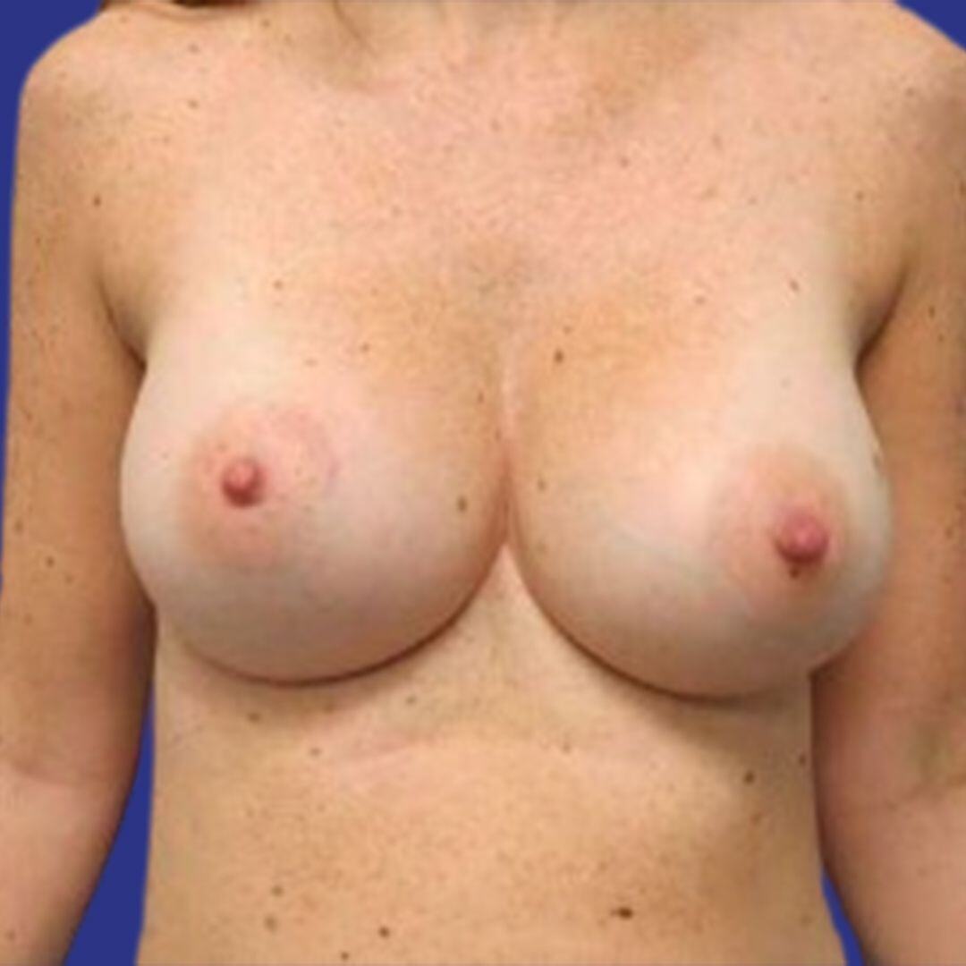 Procedure before and after - after