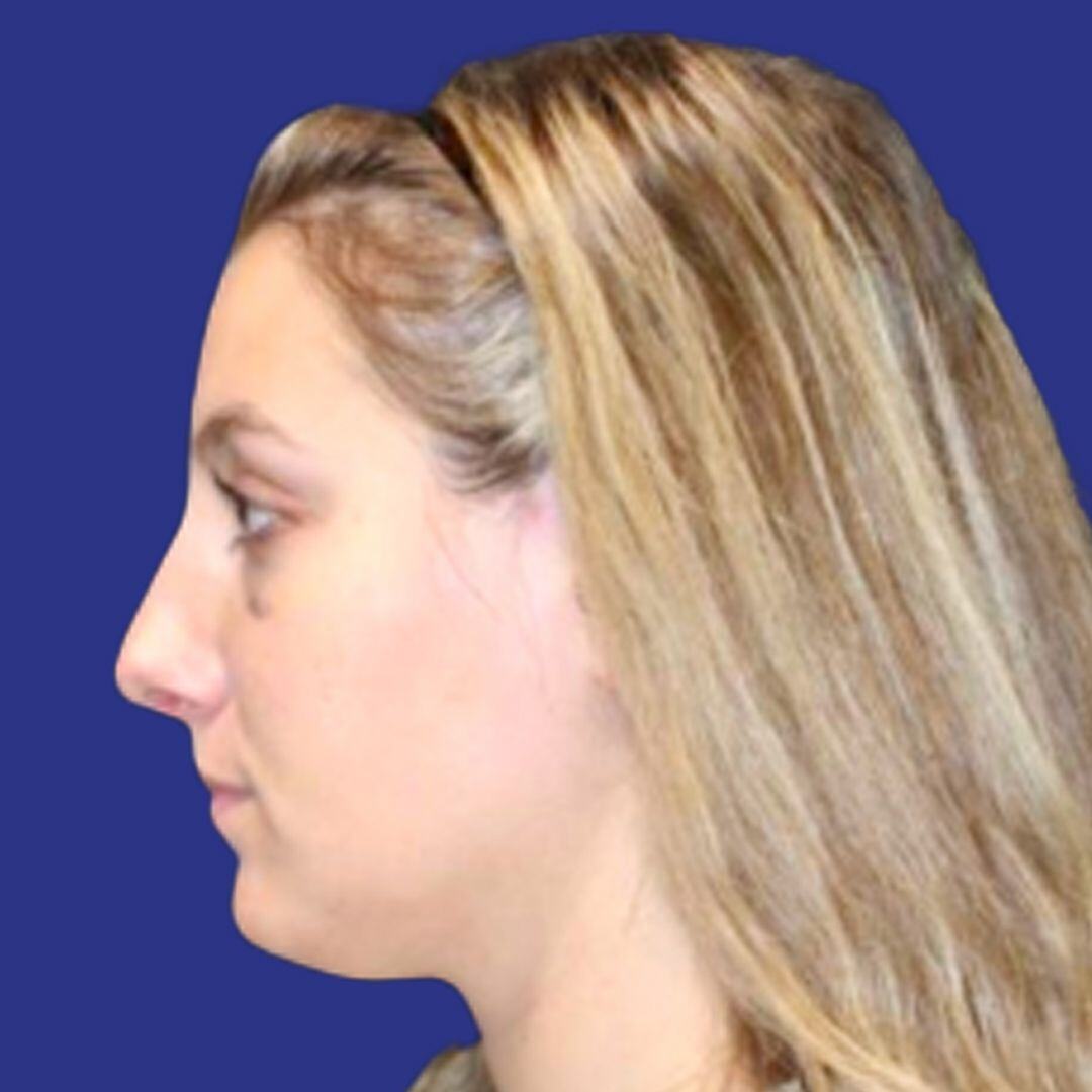 Procedure before and after - after