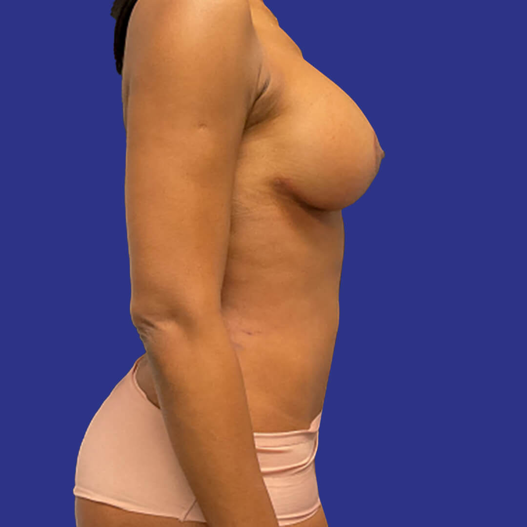 Procedure before and after - after