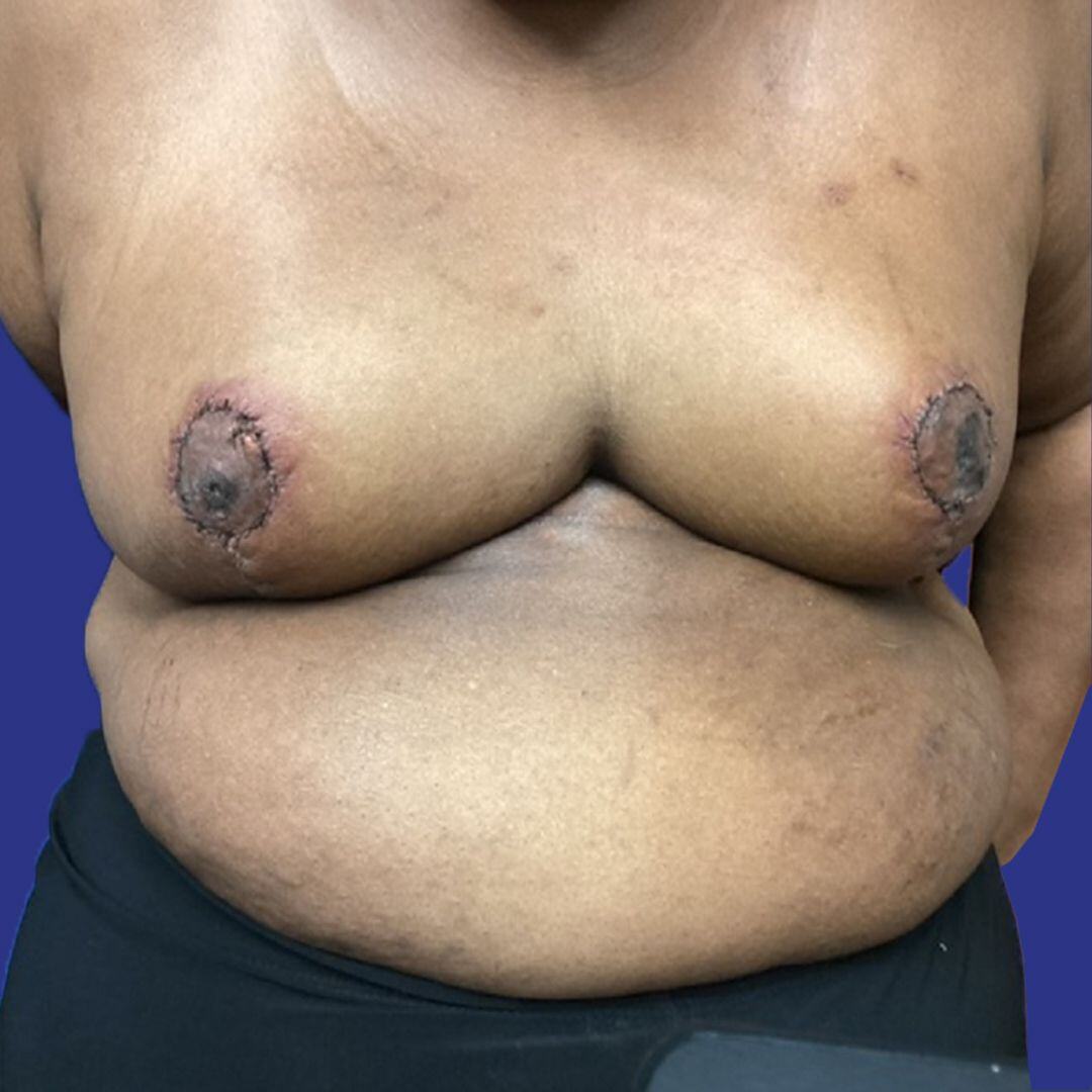 Procedure before and after - after
