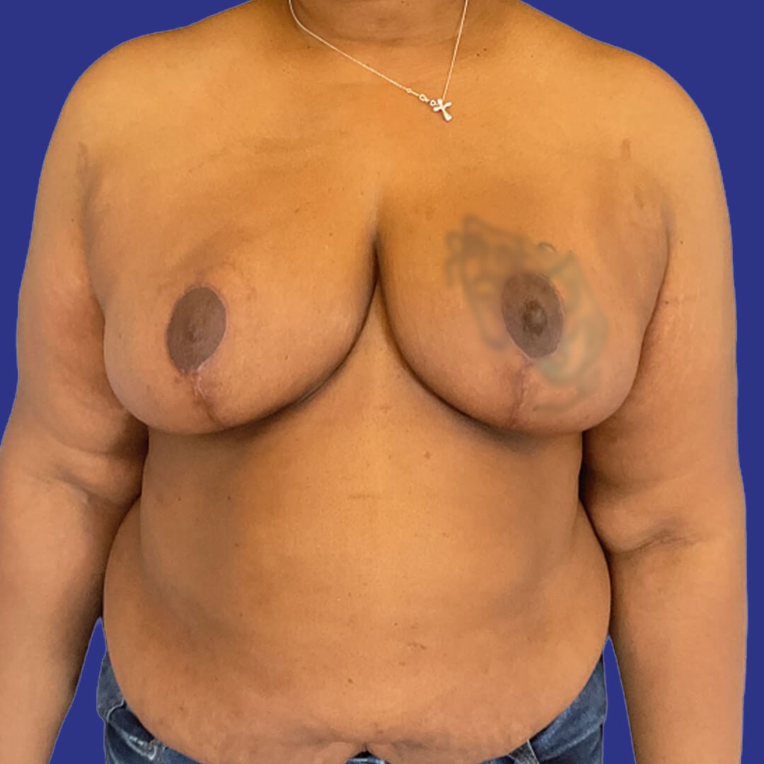 Procedure before and after - after