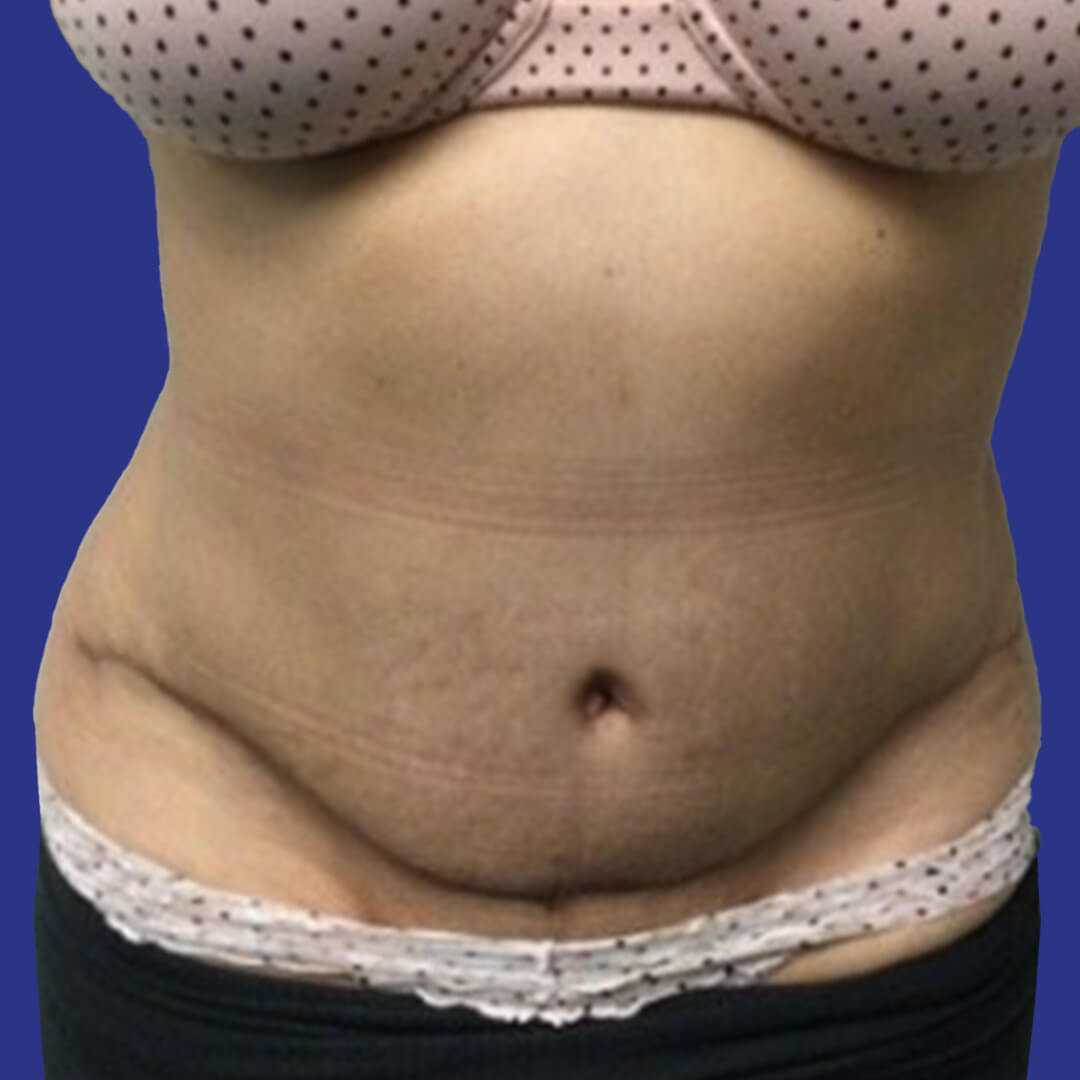 Procedure before and after - after