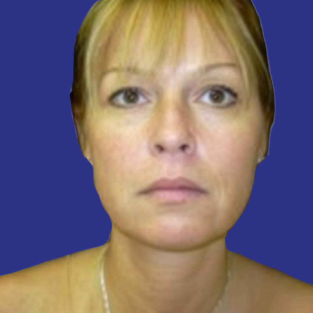 Procedure before and after - after