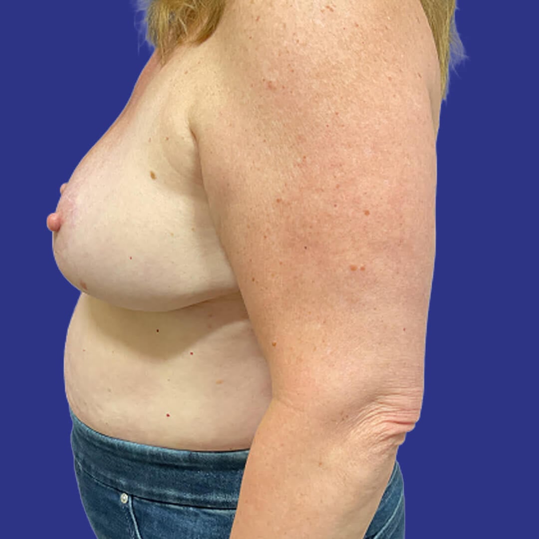 Procedure before and after - after