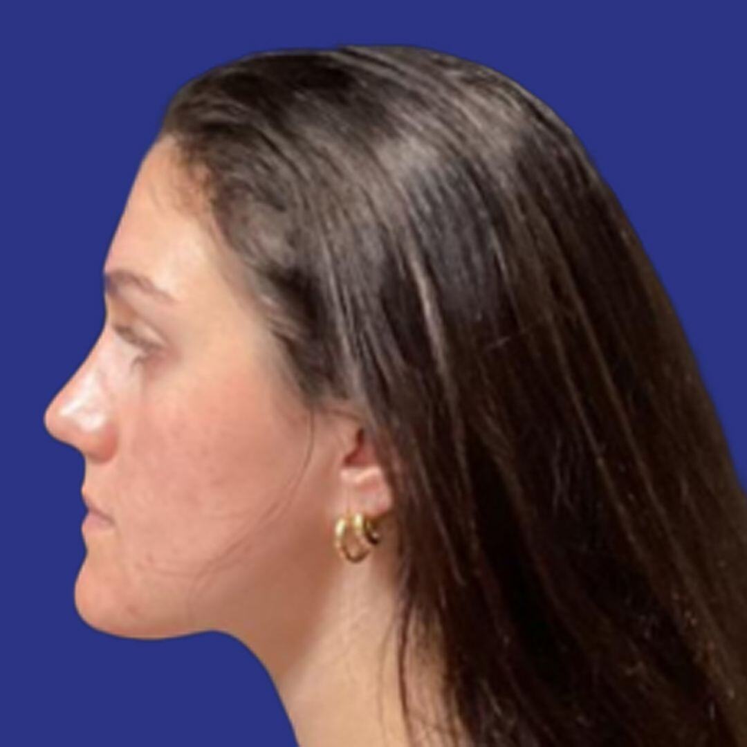 Procedure before and after - after