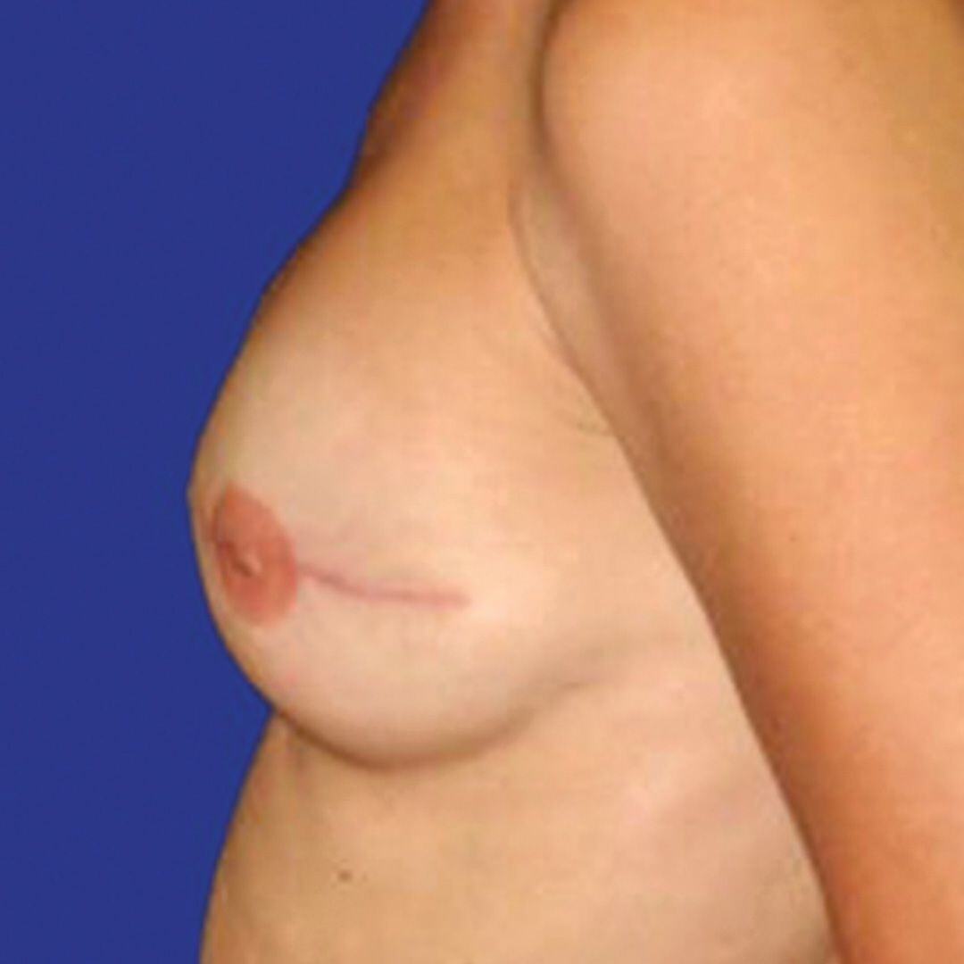 Procedure before and after - after