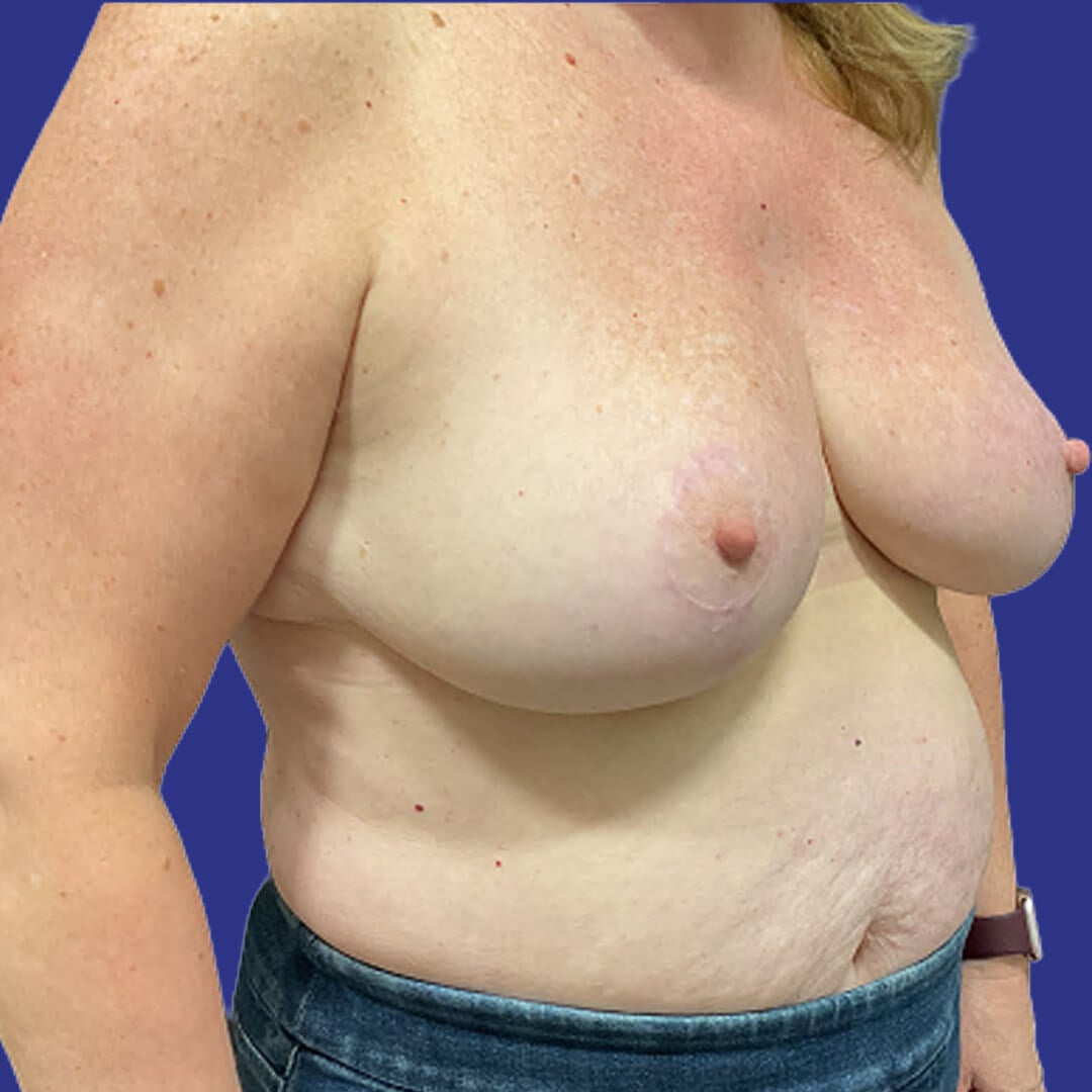 Procedure before and after - after