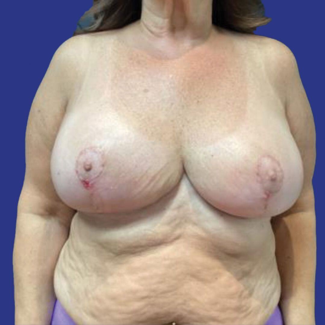 Procedure before and after - after