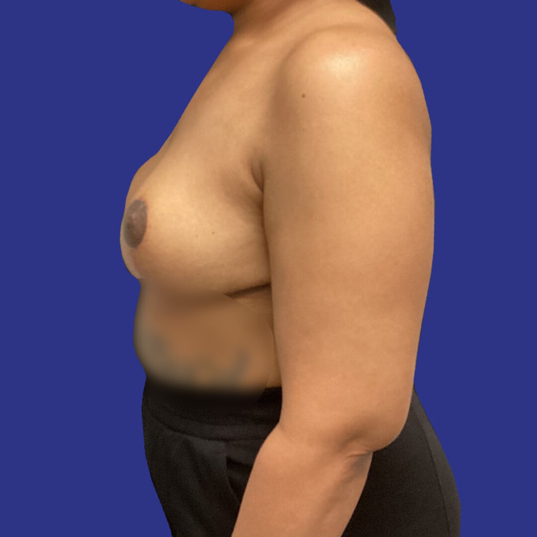Procedure before and after - after