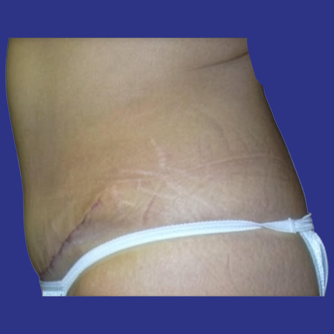 Procedure before and after - after
