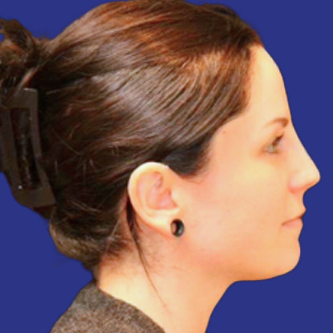 Procedure before and after - after