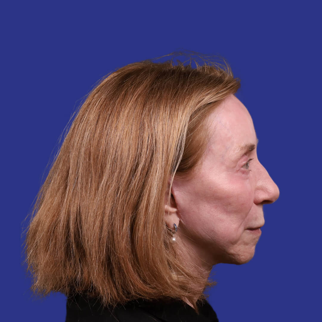 Procedure before and after - after