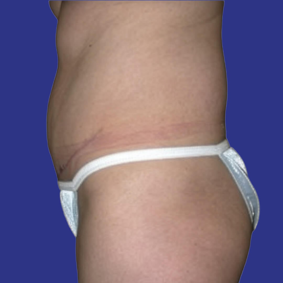 Procedure before and after - after