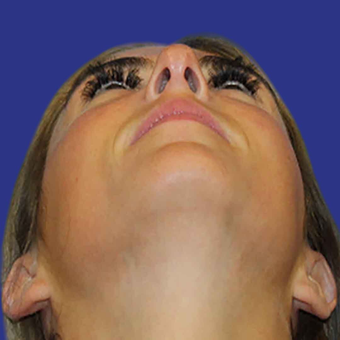 Procedure before and after - after