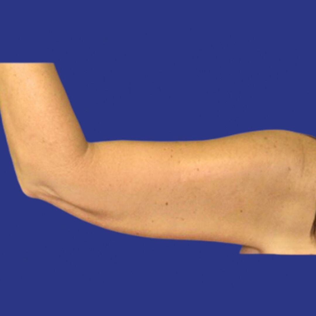 Procedure before and after - after