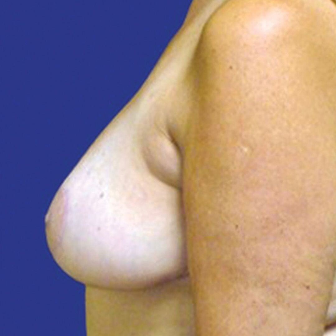 Procedure before and after - after