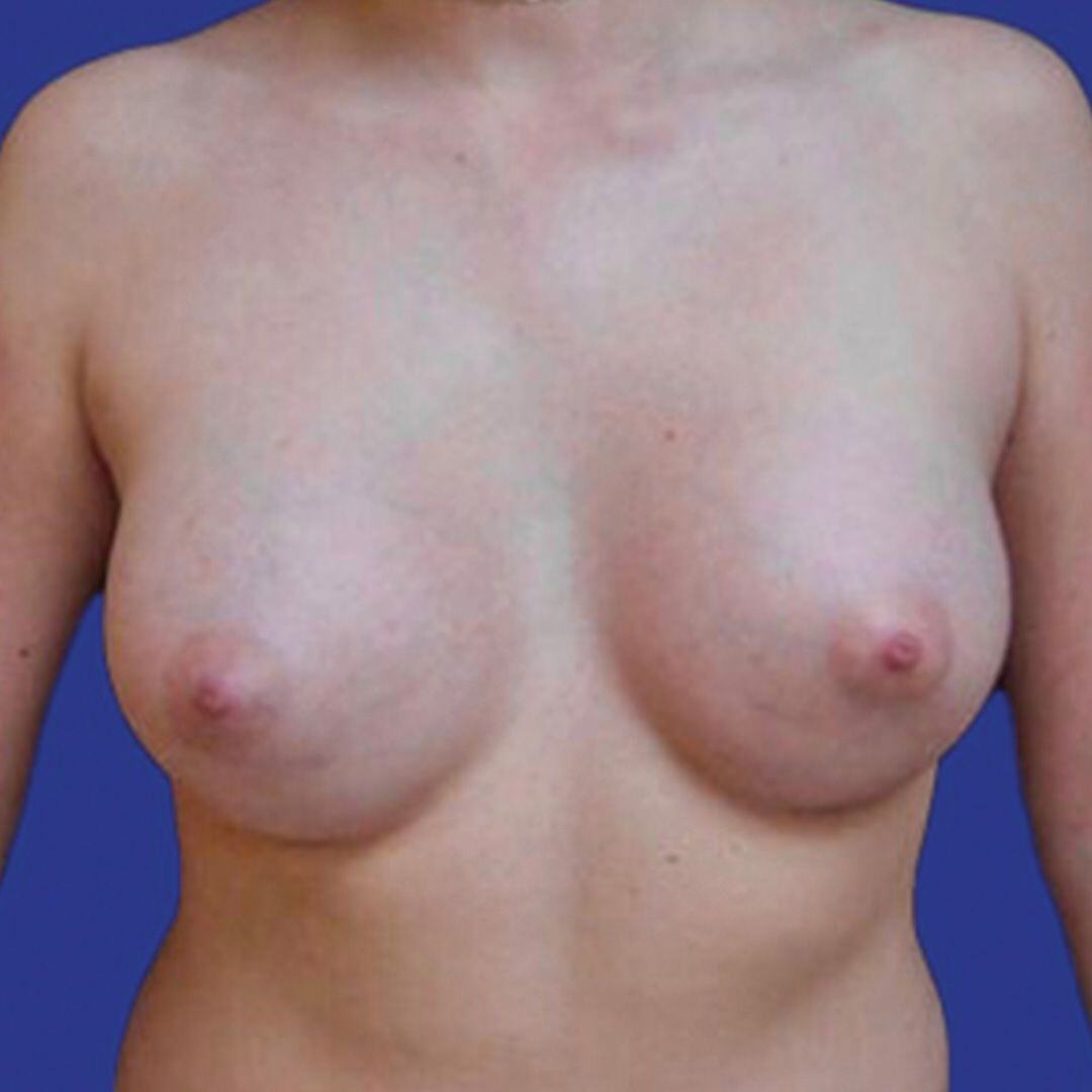 Procedure before and after - after