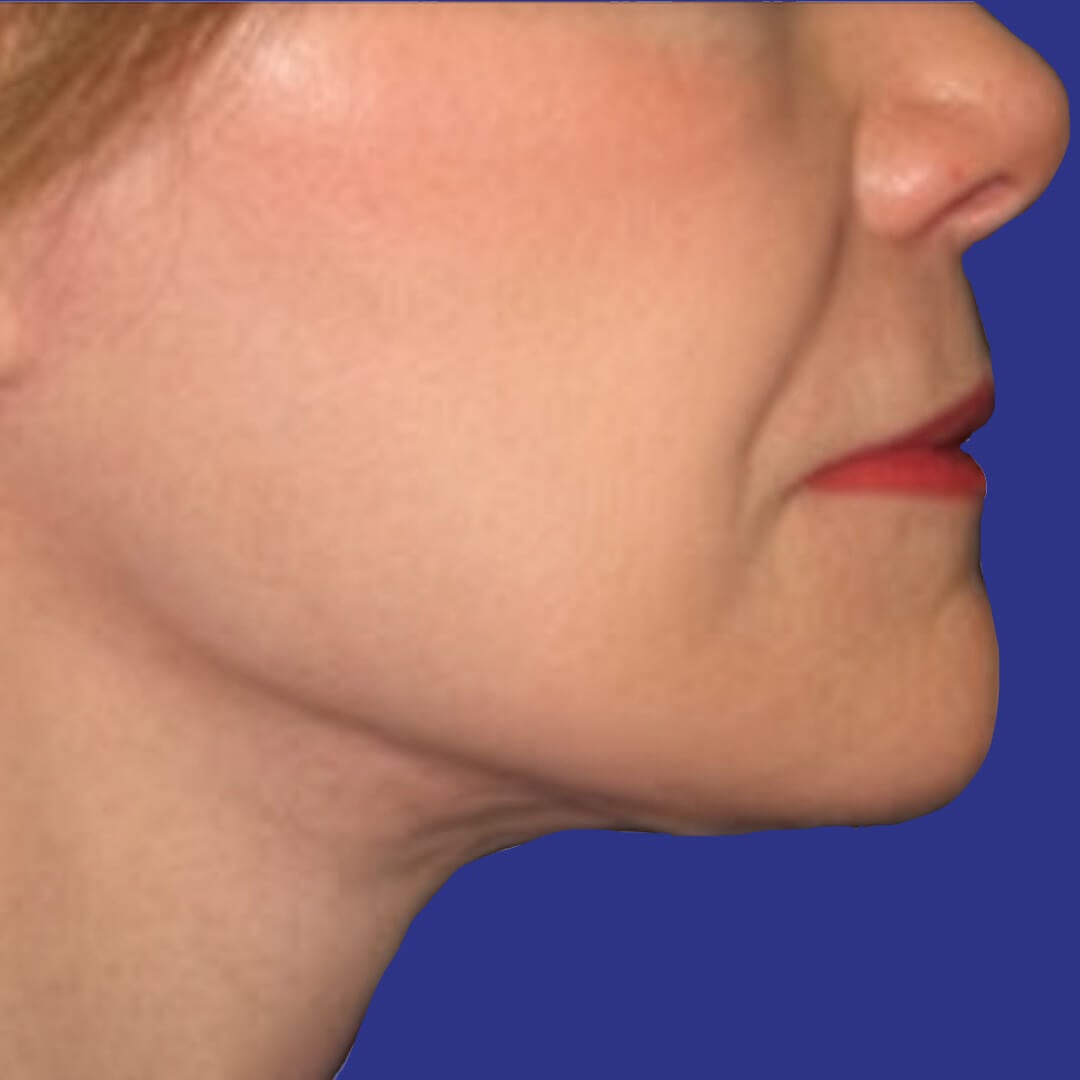 Procedure before and after - after