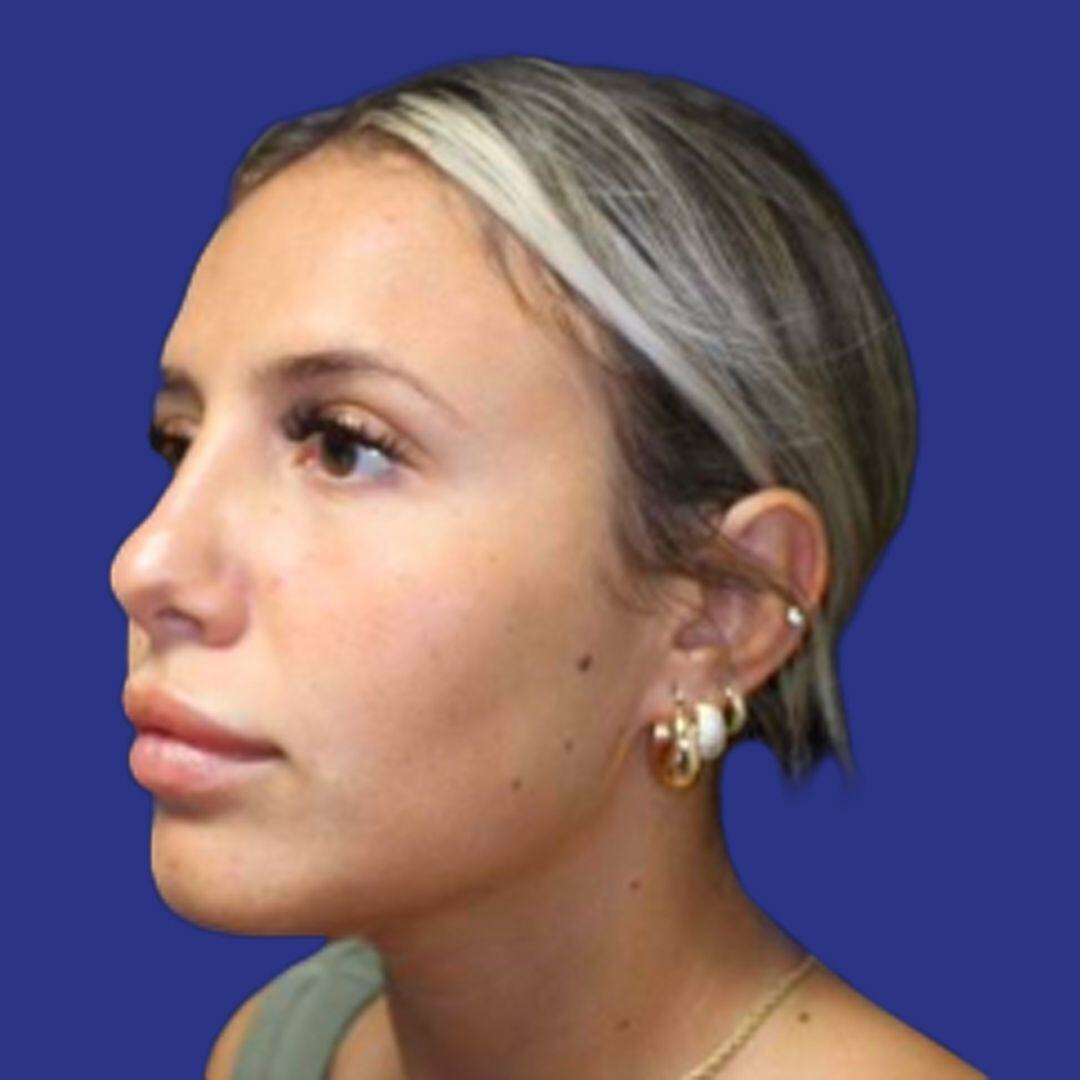 Procedure before and after - after
