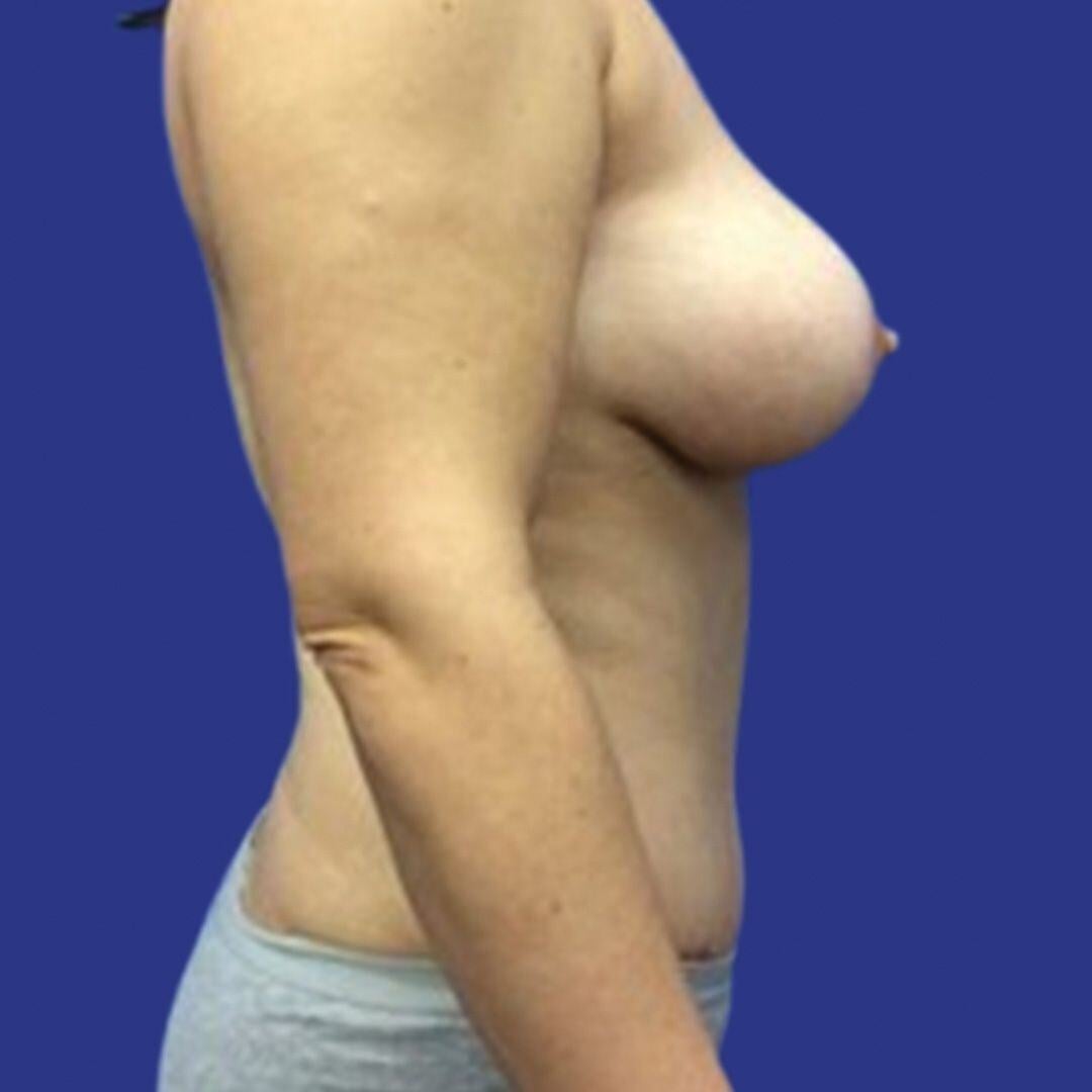 Procedure before and after - after