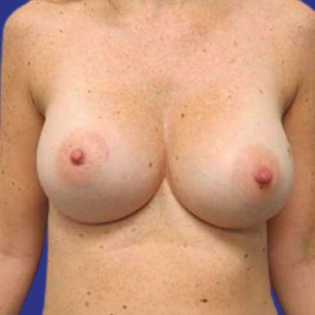 Procedure before and after - after