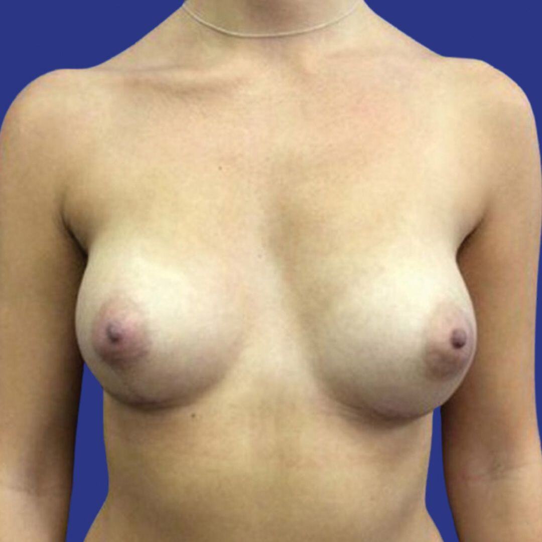 Procedure before and after - after
