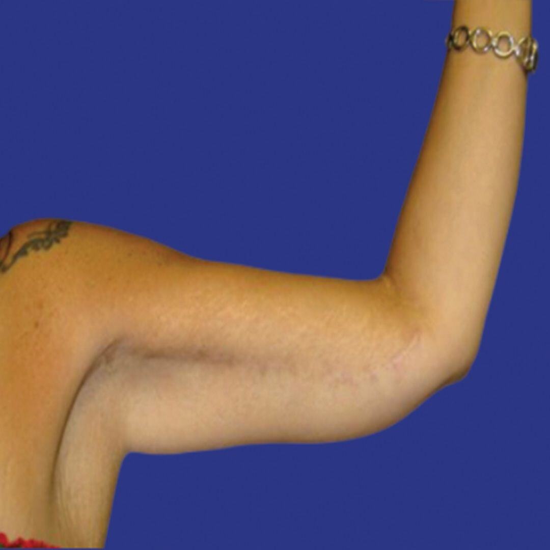 Procedure before and after - after