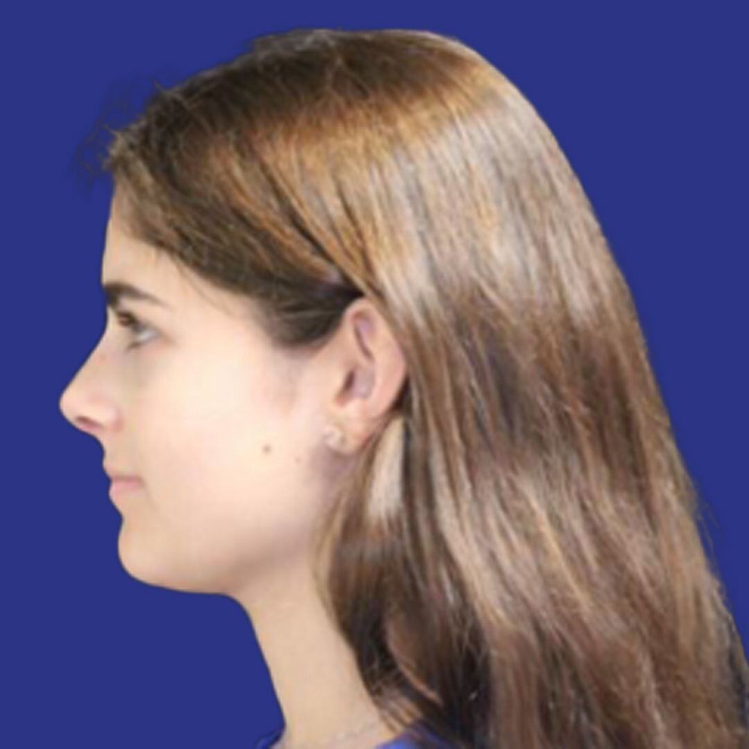 Procedure before and after - after