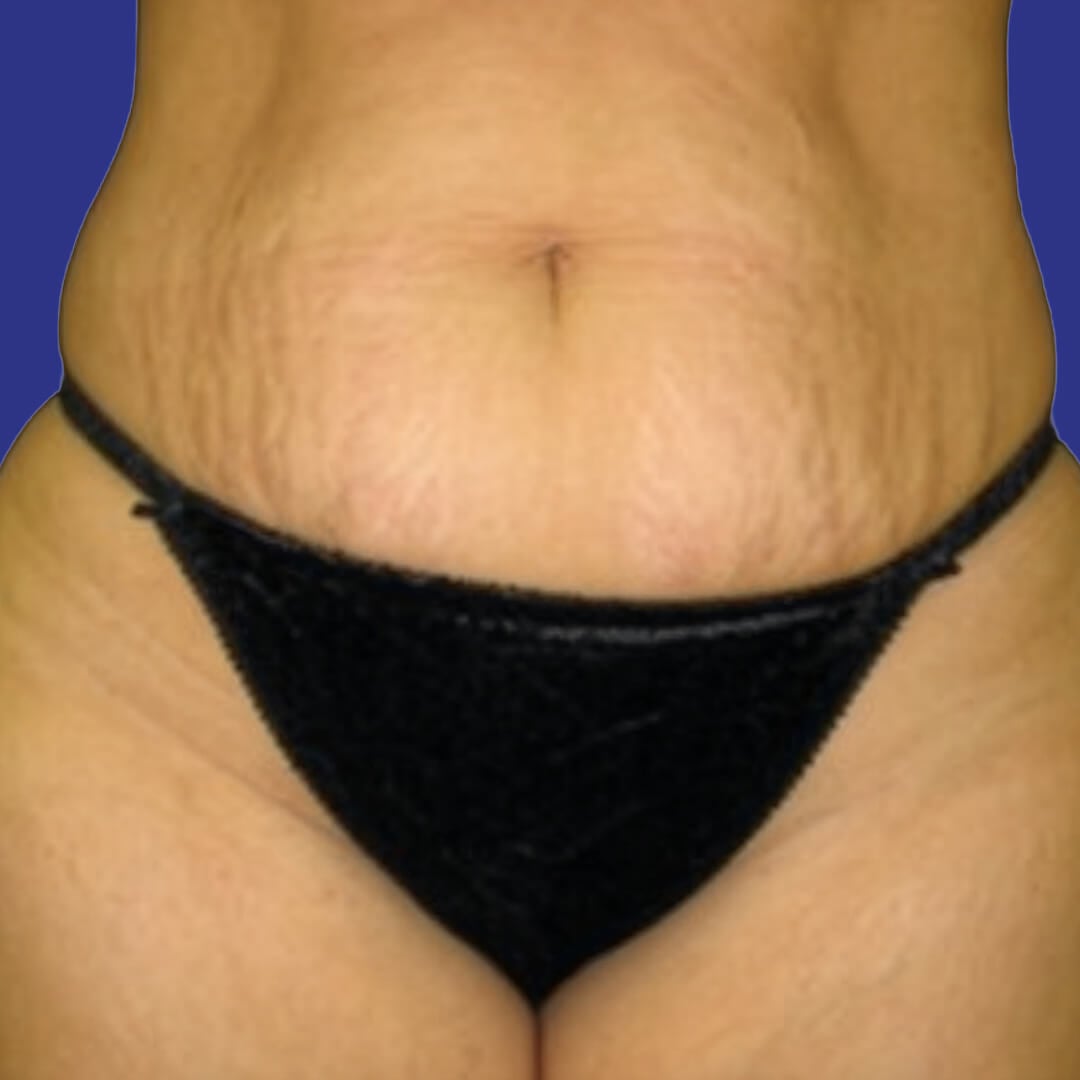 Procedure before and after - before