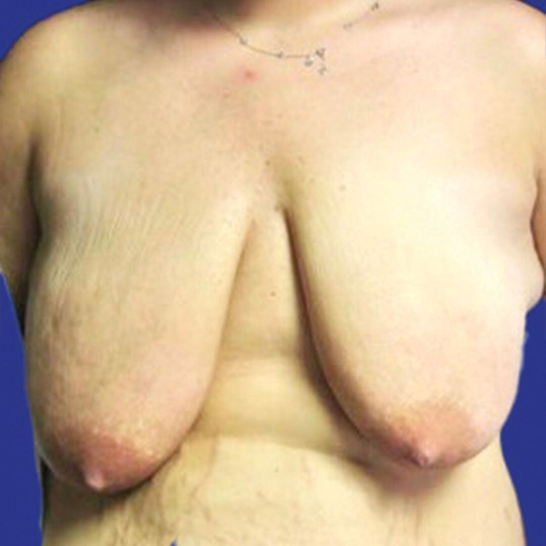 Procedure before and after - before