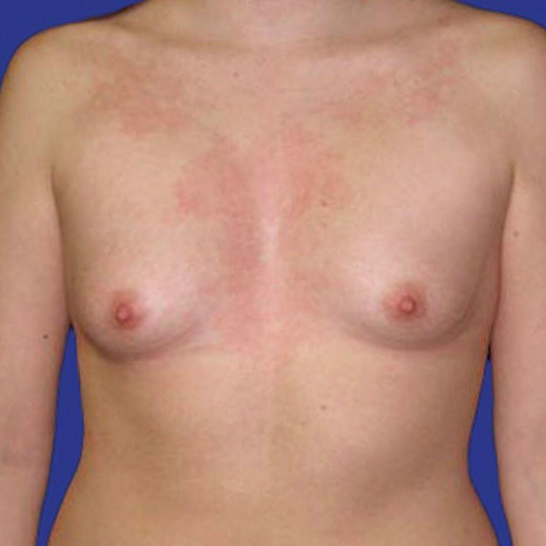 Procedure before and after - before