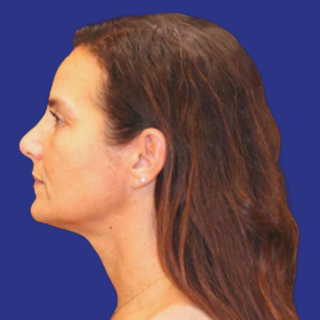 Procedure before and after - before