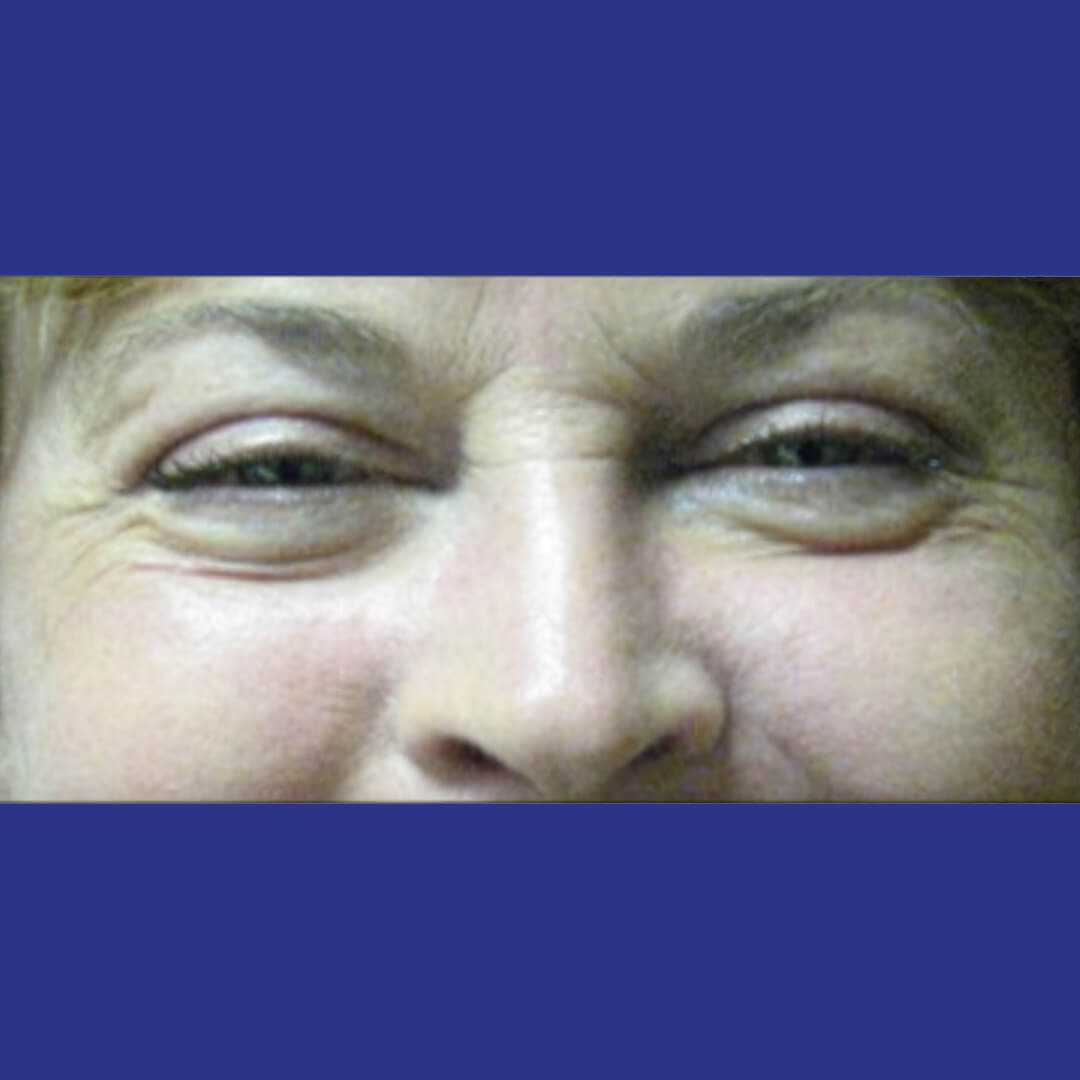 Procedure before and after - before