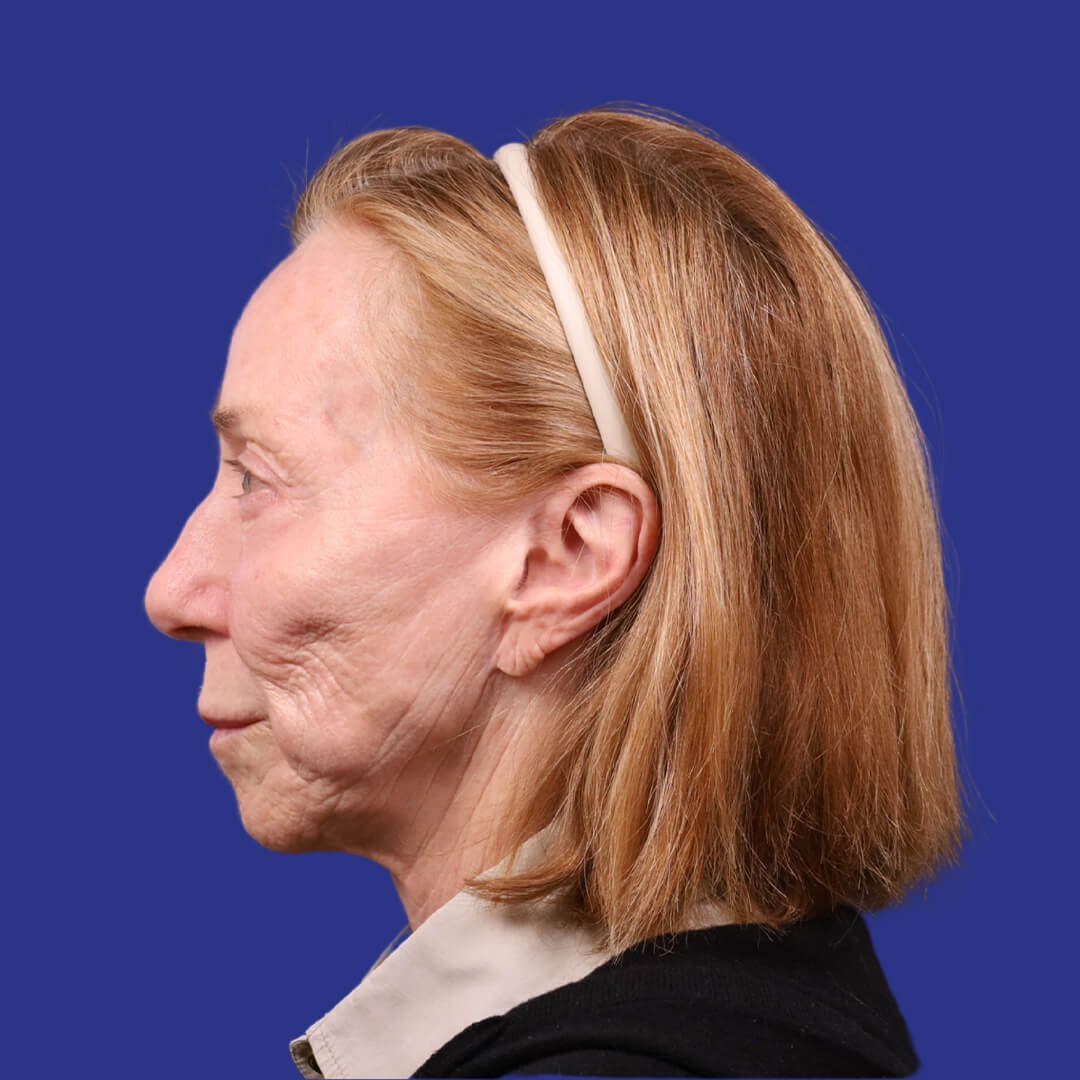 Procedure before and after - before