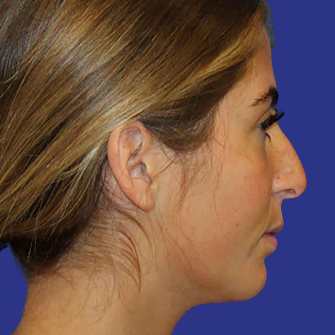 Procedure before and after - before