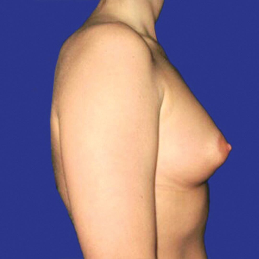 Procedure before and after - before