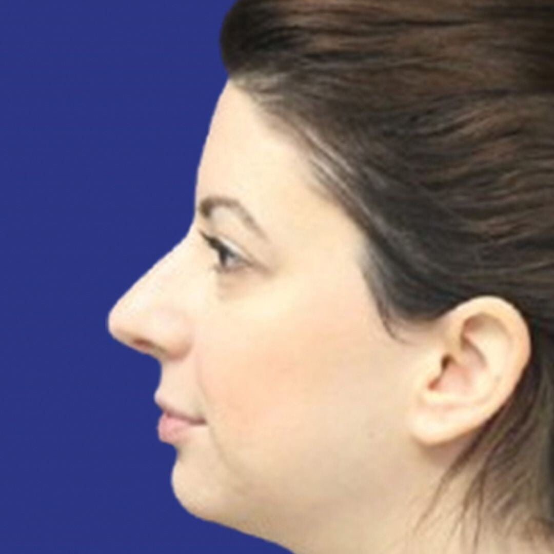 Procedure before and after - before
