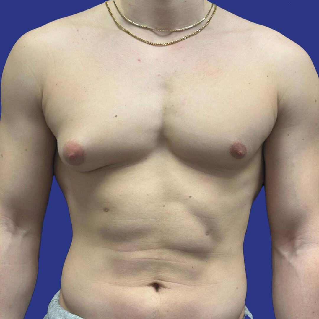 Procedure before and after - before