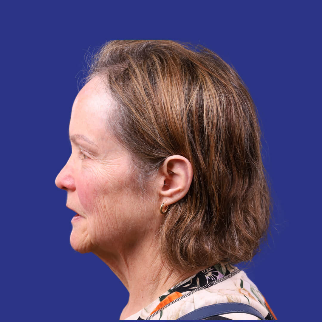 Procedure before and after - before
