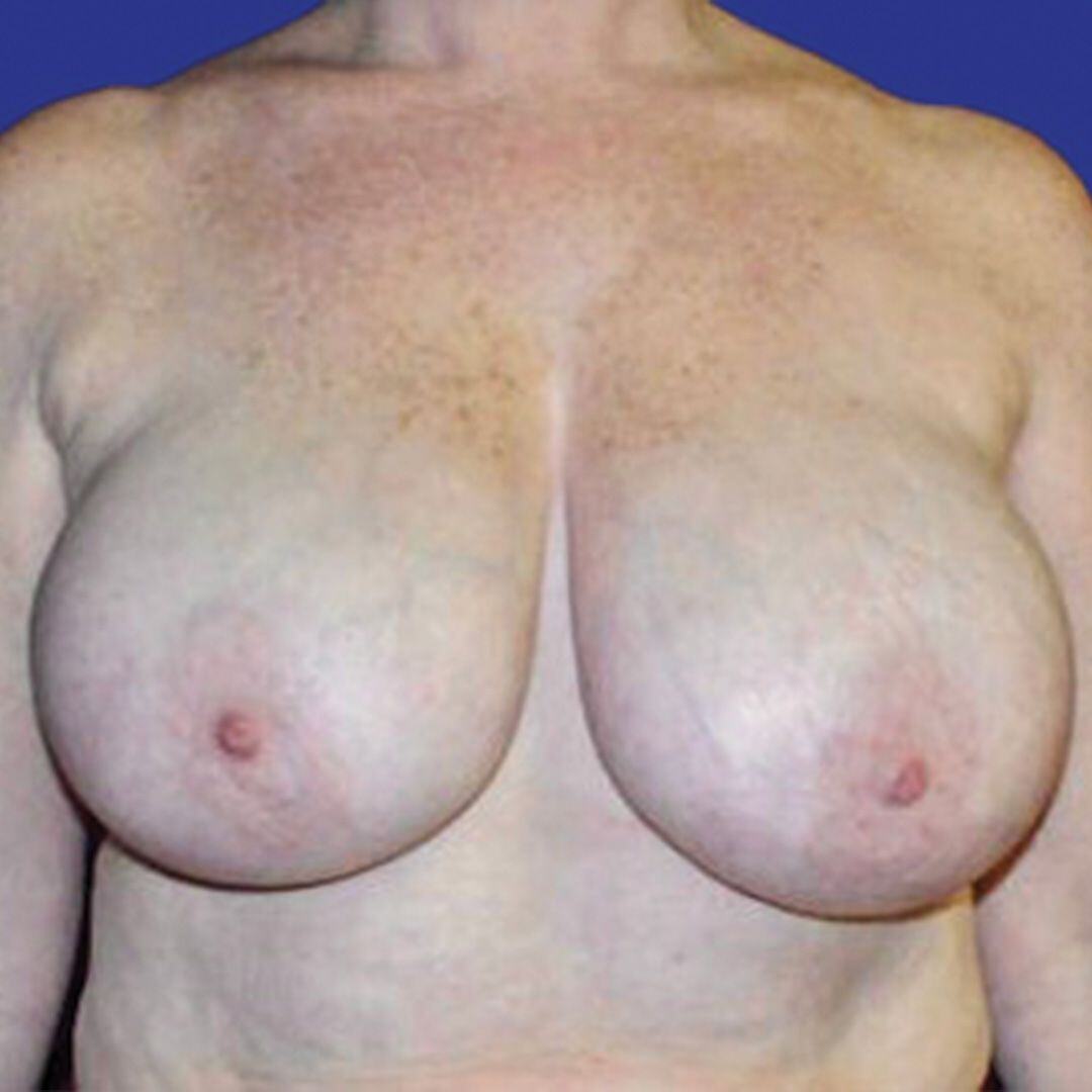 Procedure before and after - before