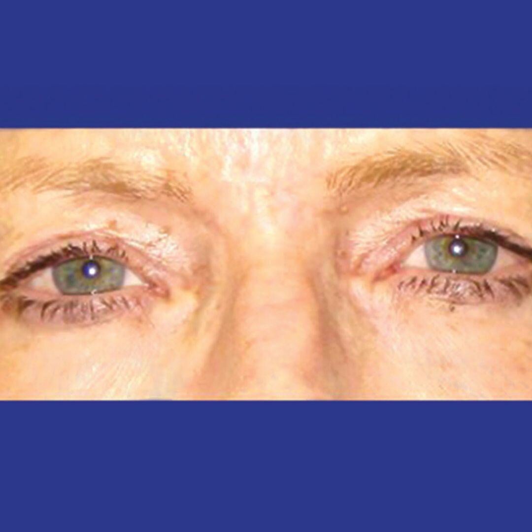 Procedure before and after - before