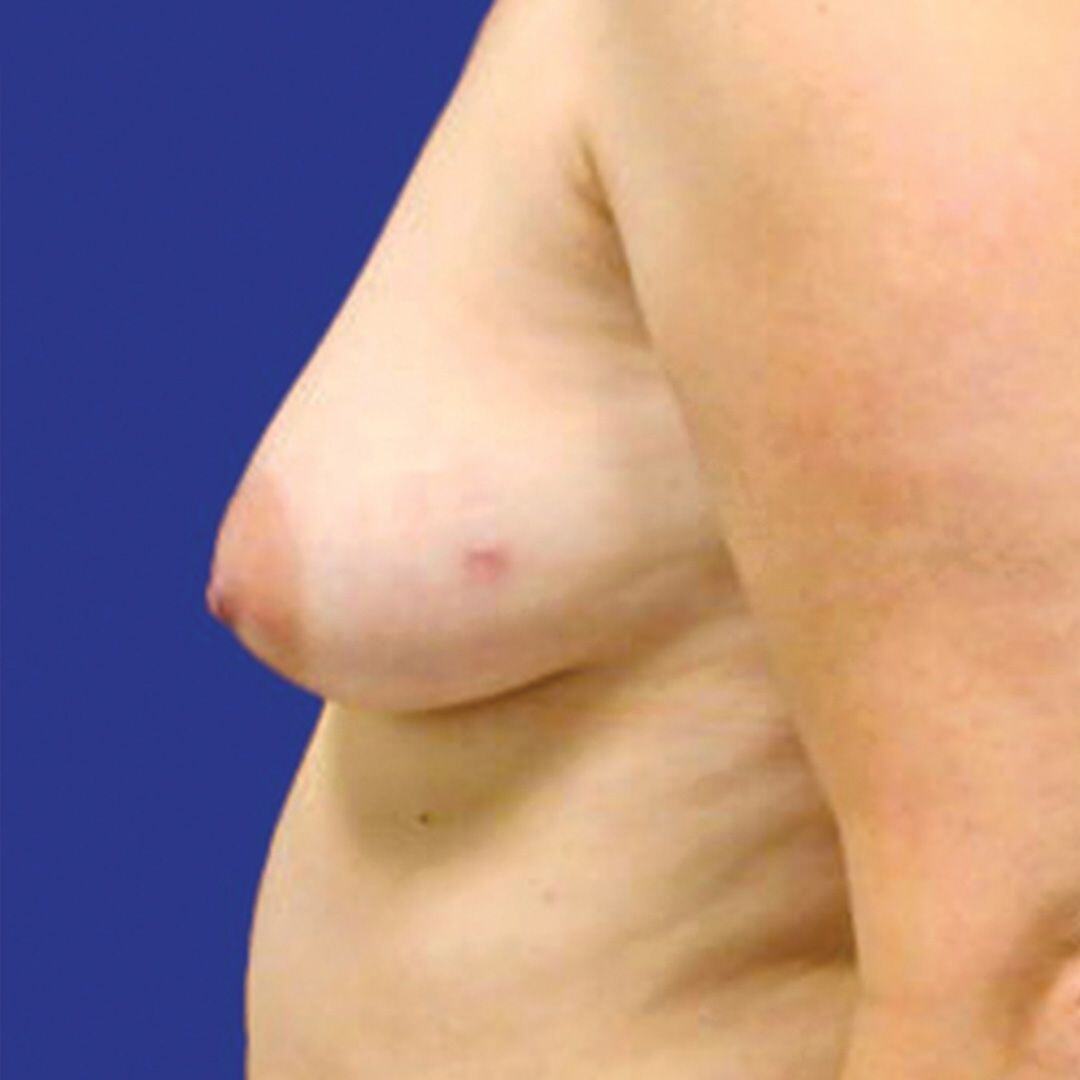Procedure before and after - before