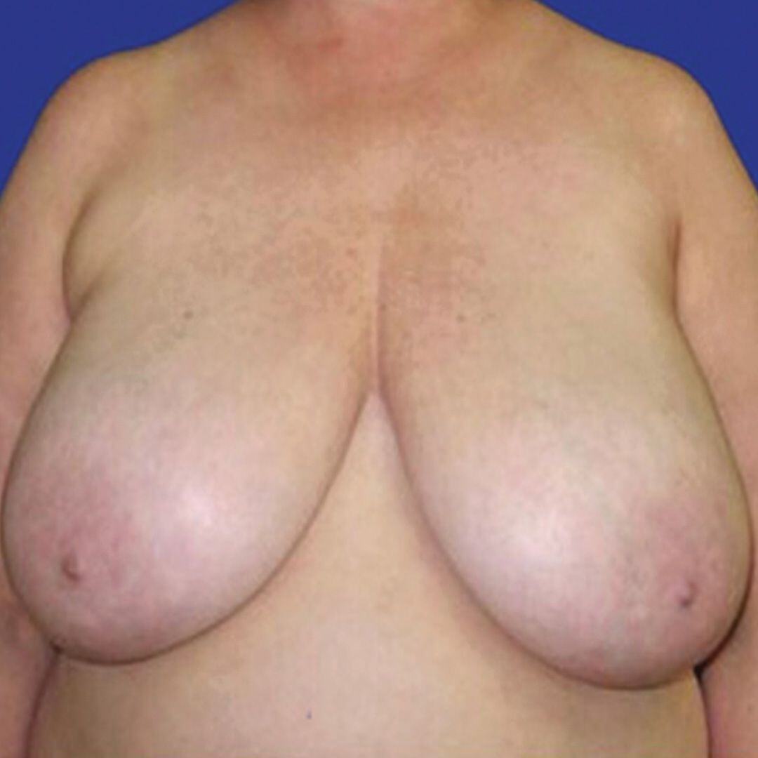 Procedure before and after - before