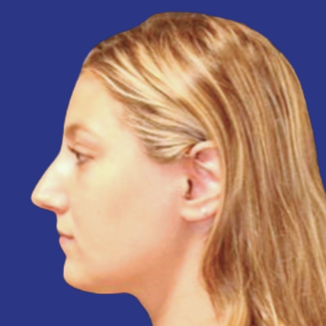 Procedure before and after - before