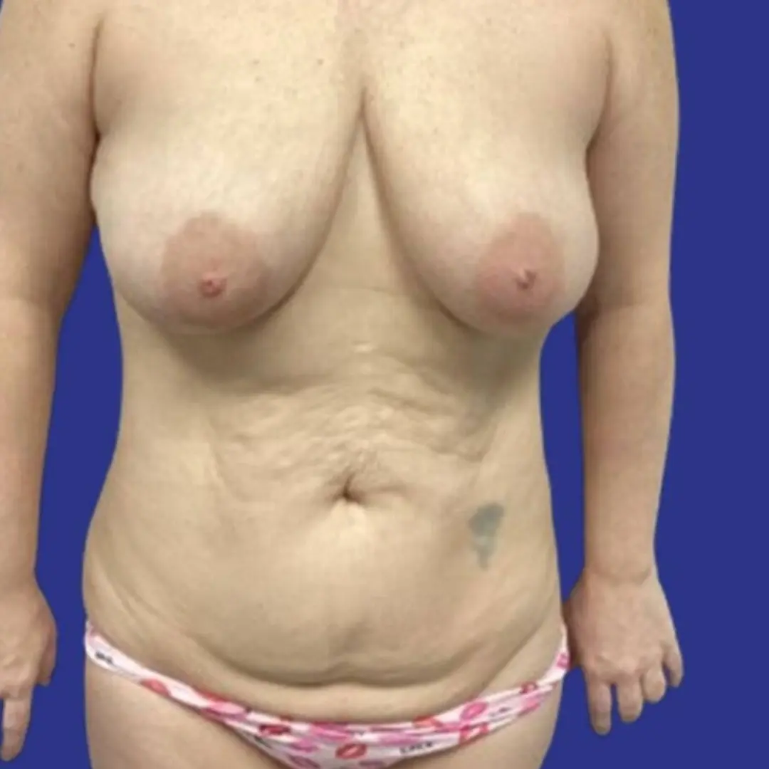 Procedure before and after - before