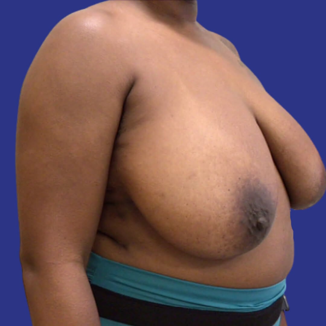 Procedure before and after - before