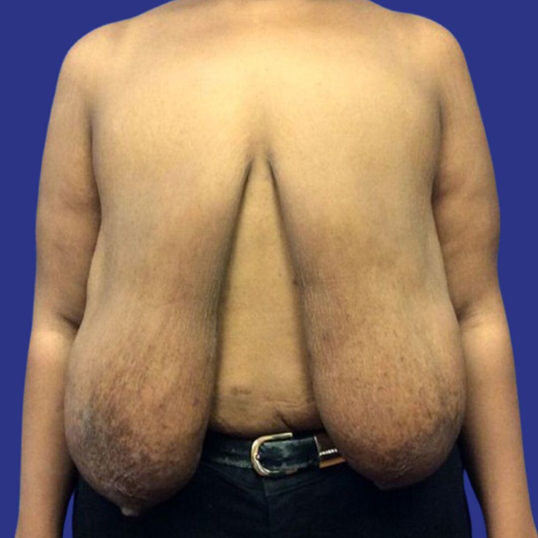 Procedure before and after - before