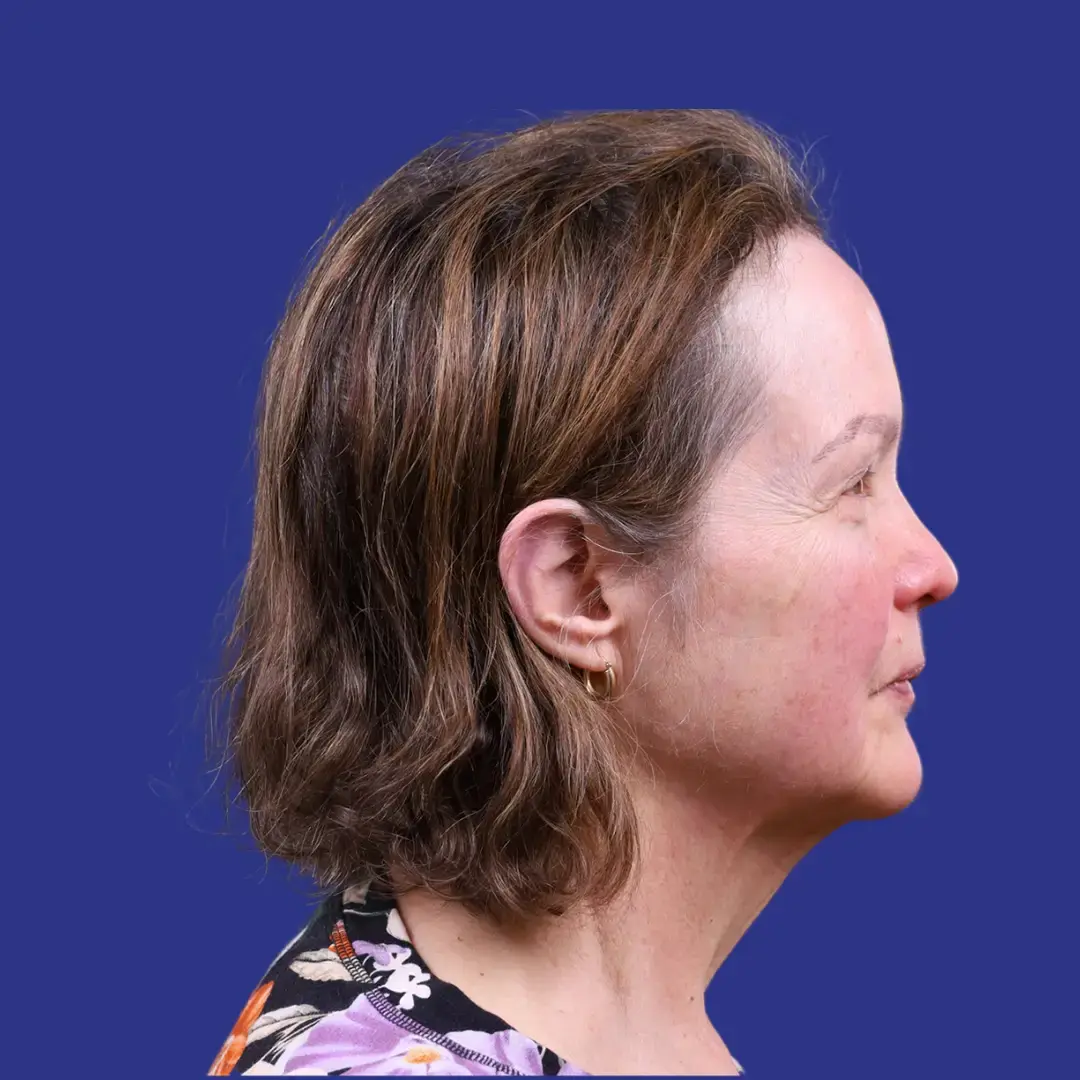 Procedure before and after - before