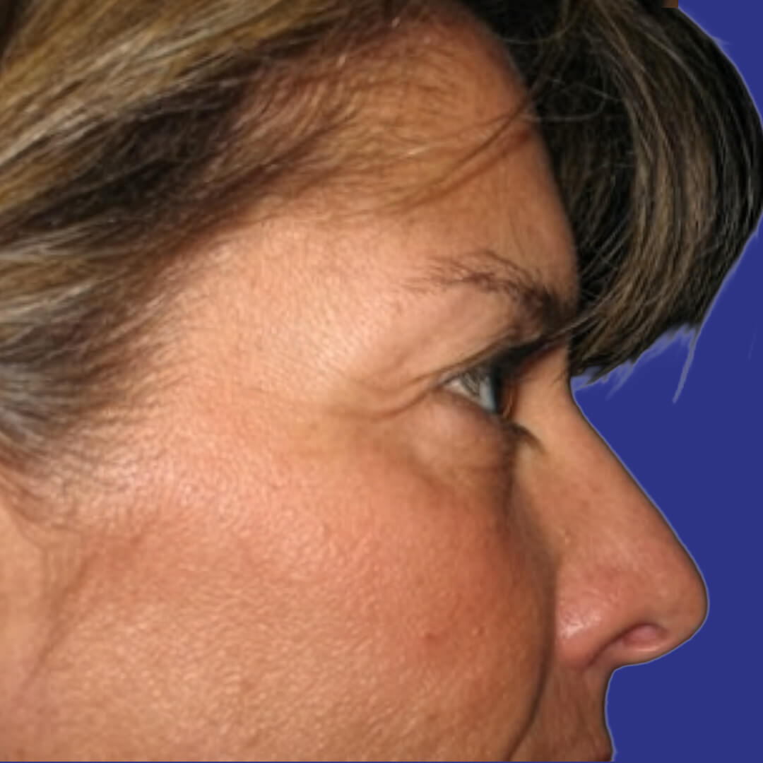 Procedure before and after - before